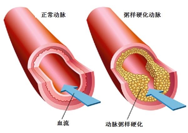 動脈硬化大百科：動脈粥樣硬化的發(fā)生機制